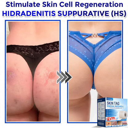 👩‍⚕️☘️Celsiora® Multi-Functional Microneedle Hydrocolloid Patch Roll | Targets Skin Tags, Warts & Stubborn Blemishes