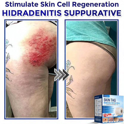 👩‍⚕️☘️Celsiora® Multi-Functional Microneedle Hydrocolloid Patch Roll | Targets Skin Tags, Warts & Stubborn Blemishes