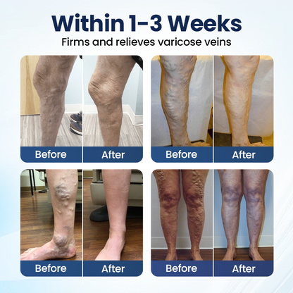 Owiwell® Deep Vein Repair Microneedle Patch