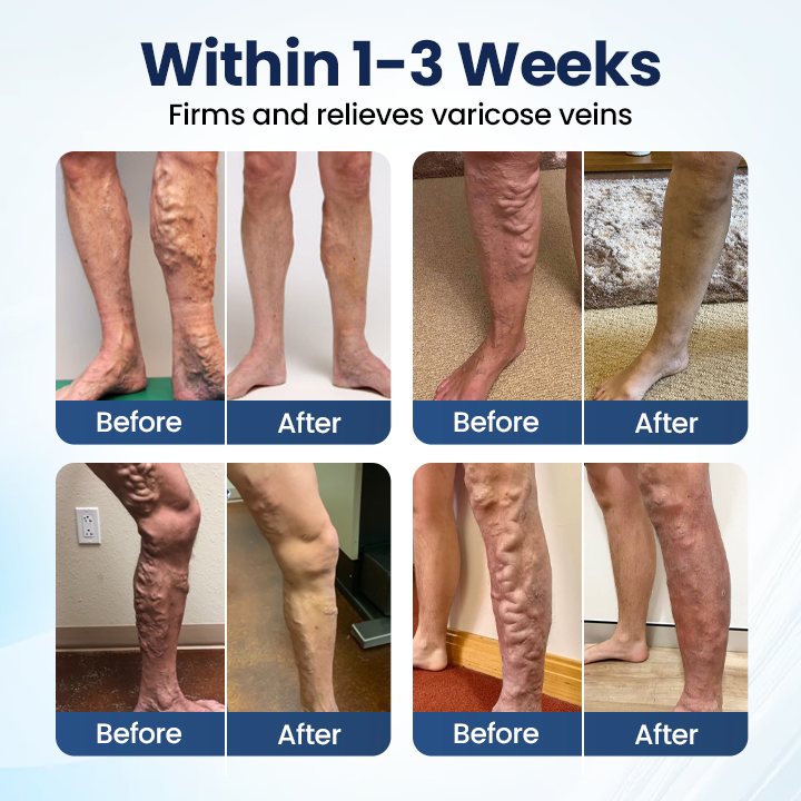 Owiwell® Deep Vein Repair Microneedle Patch