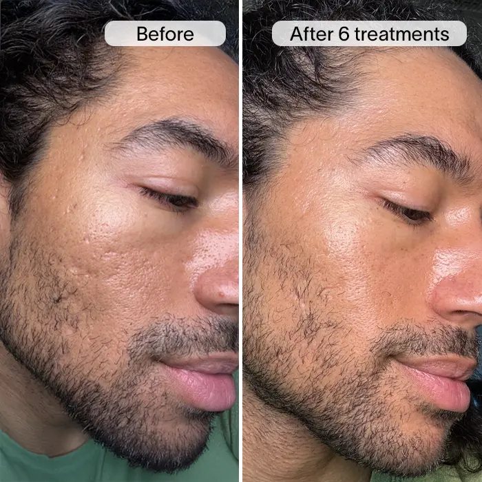 PDRN Advanced Infusion Treatment