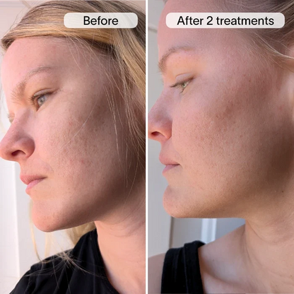 PDRN Advanced Infusion Treatment