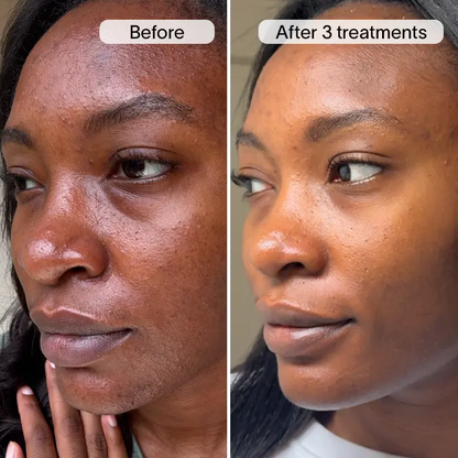 PDRN Advanced Infusion Treatment