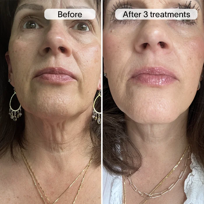 PDRN Advanced Infusion Treatment