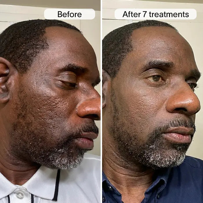 PDRN Advanced Infusion Treatment