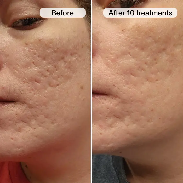 PDRN Advanced Infusion Treatment