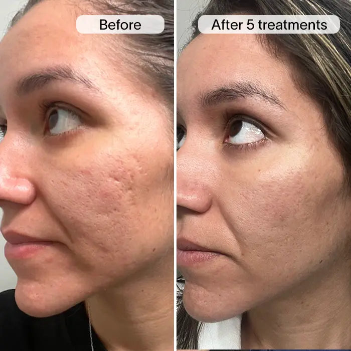 PDRN Advanced Infusion Treatment