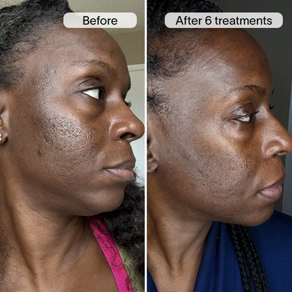 PDRN Advanced Infusion Treatment