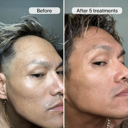 PDRN Advanced Infusion Treatment