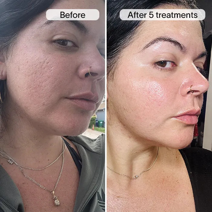 PDRN Advanced Infusion Treatment